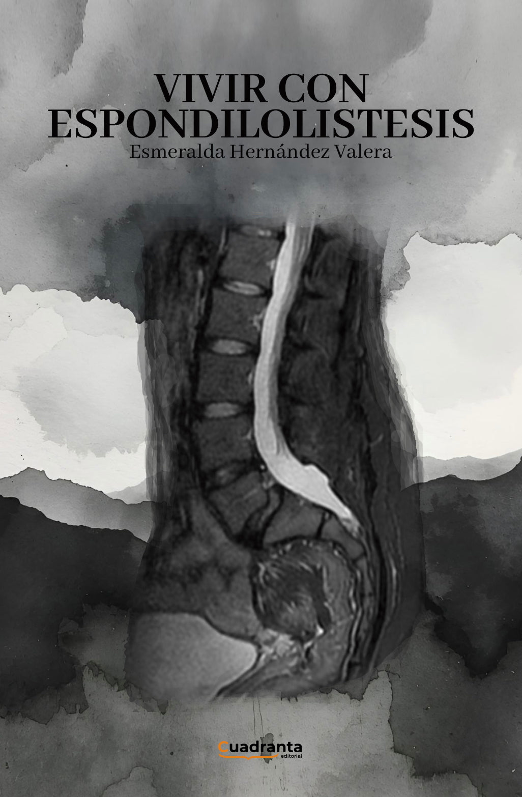 Vivir con espondilolistesis