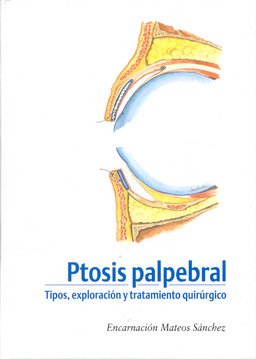 Ptosis palpebral
