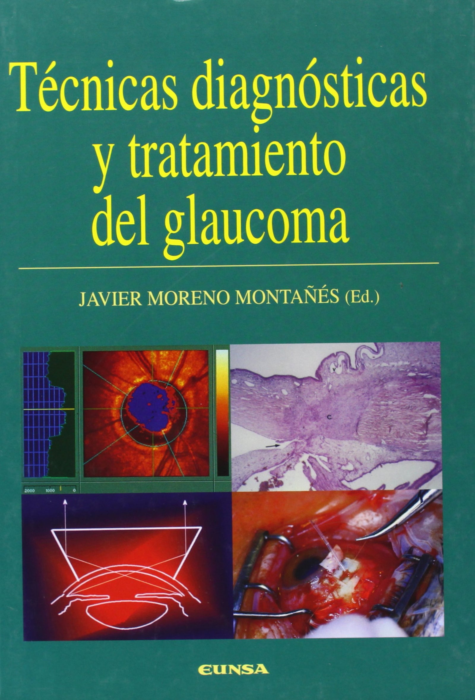 Técnicas diagnósticas y tratamiento del glaucoma (Libros de medicina)